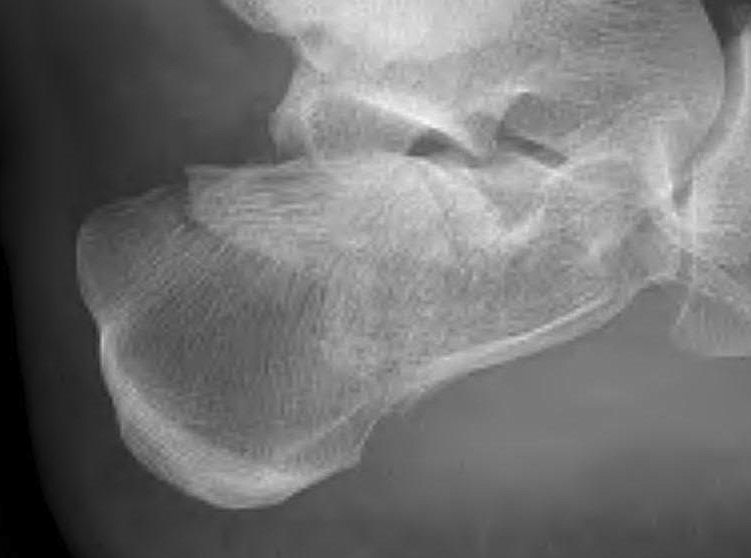 Calcaneal Fracture Joint Depression